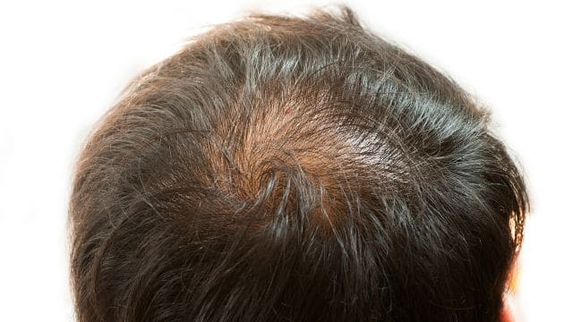 Understanding Hair Loss and Follicle Function